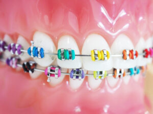 What Color Braces Should I Get? Quiz Best Braces Color