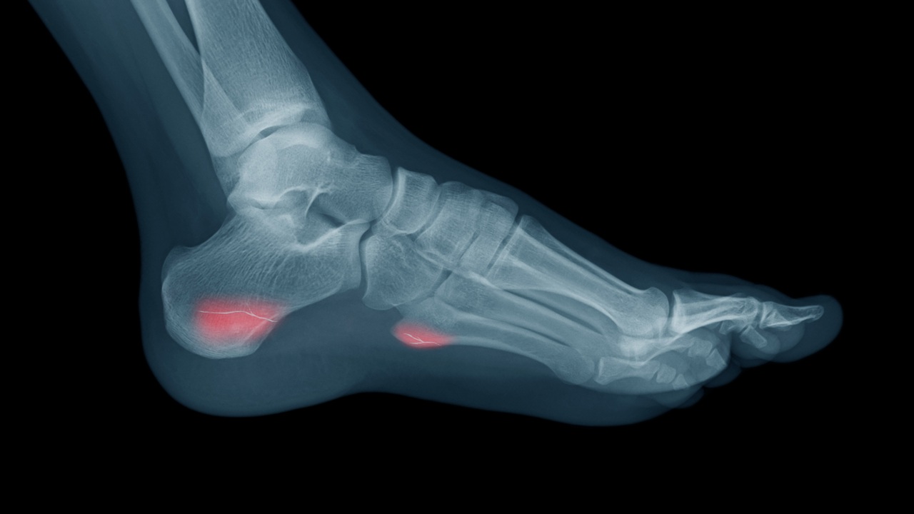 do-i-have-a-stress-fracture-quiz Do I Have A Stress Fracture Quiz